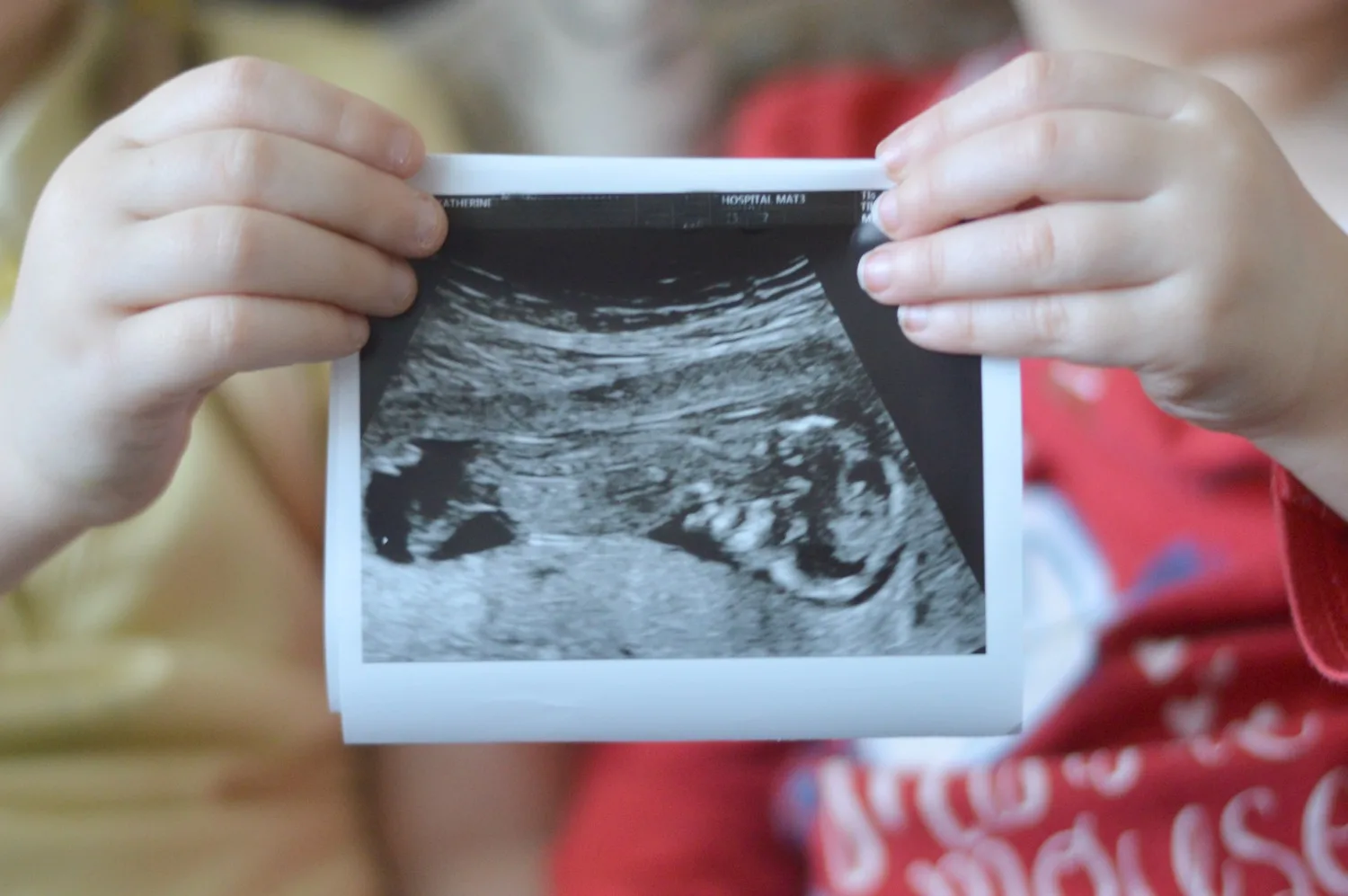 Baby 12 week scan