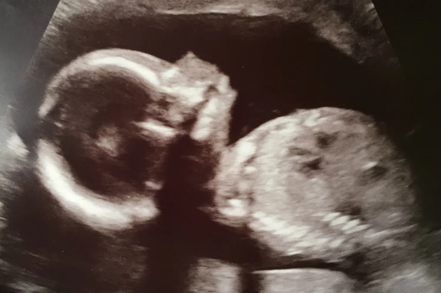 Baby 20 week scan